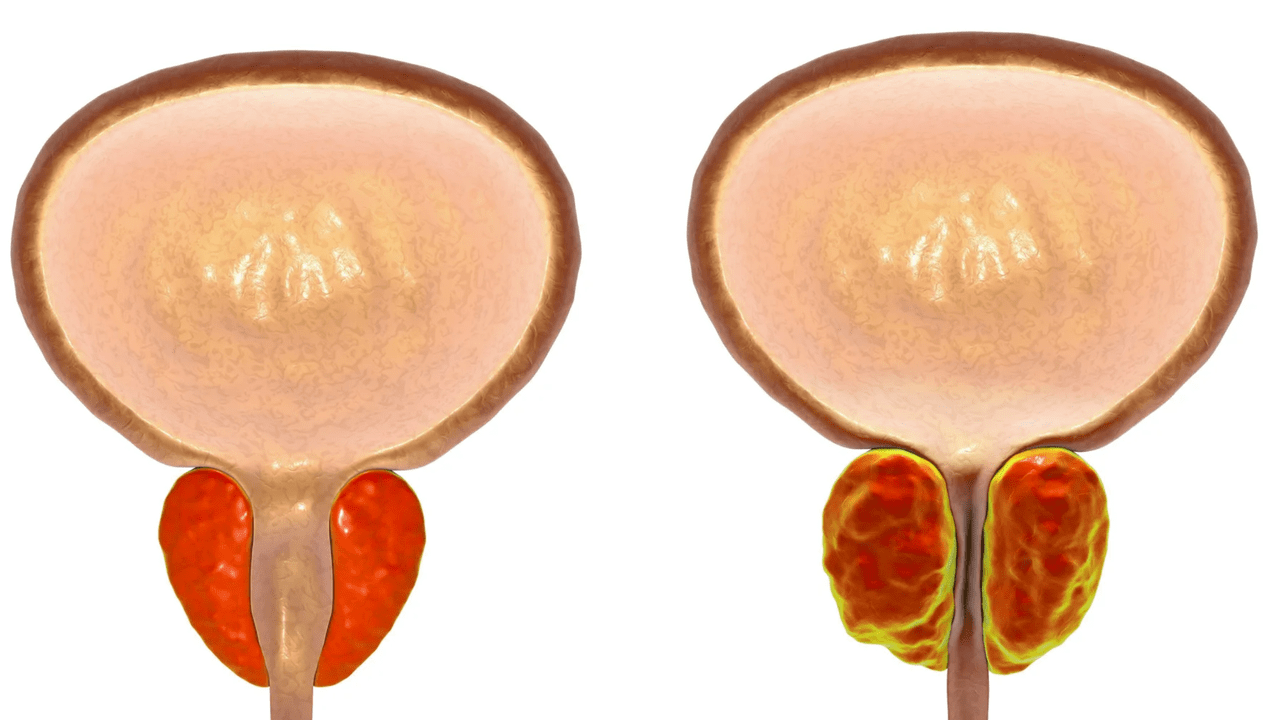 Τι είναι η προστατίτιδα;