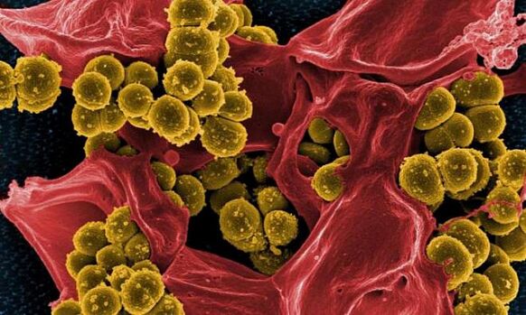 Staphylococcus aureus ως αιτία βακτηριακής προστατίτιδας